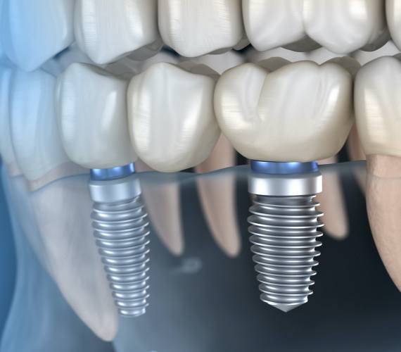 two dental implants in Fort Worth supporting a dental bridge