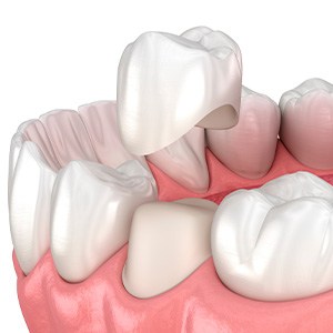 A single dental crown