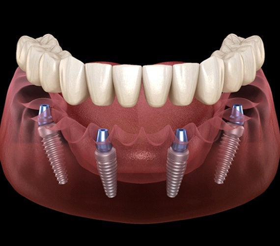 Illustration of All-on-4 in Forth Worth, TX for lower arch