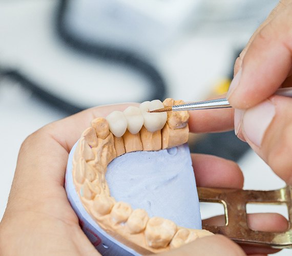 Dental crown on a model of the teeth