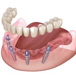 Exploded illustration of all-on-4 dentures
