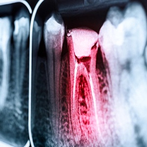 X-ray of a toothache in Fort Worth