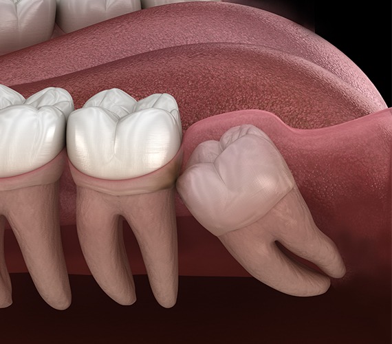 Animated smile with impacted tooth in need of extraction