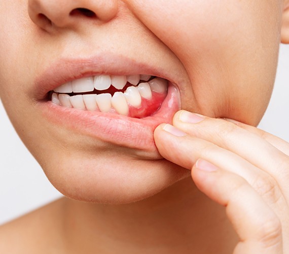 Person showing red and inflamed gums