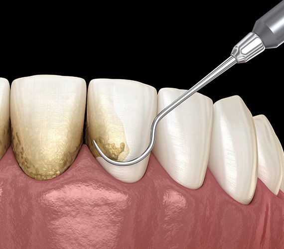Digital image of scaling and root planing