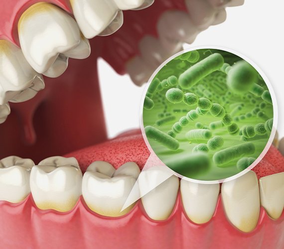 Digital image of mouth mold and bacteria underneath the gums
