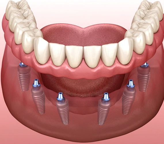 Diagram of implant dentures in Fort Worth