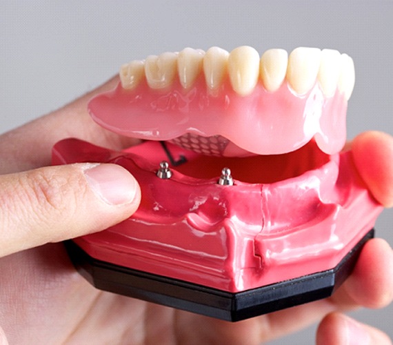 Closeup of an implant denture in Fort Worth