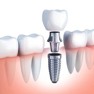 single dental implant in Fort Worth