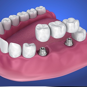 implant bridge in Fort Worth