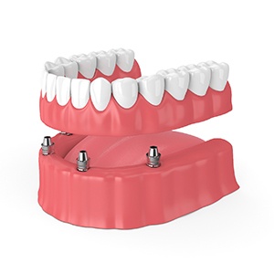 implant dentures in Fort Worth