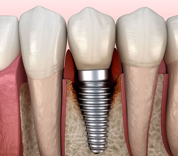Failed dental implant in Fort Worth