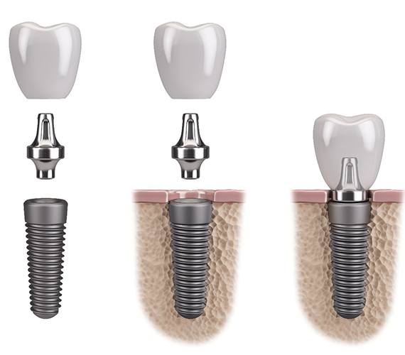 diagram showing how dental implants work in Fort Worth