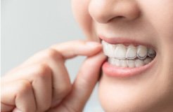 Closeup of patient placing clear aligners on top teeth