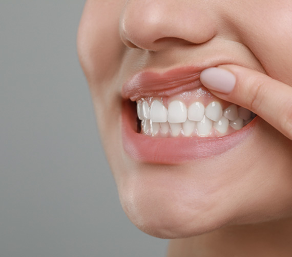 Gum recontouring resculpts periodontal tissue to make your smile more balanced