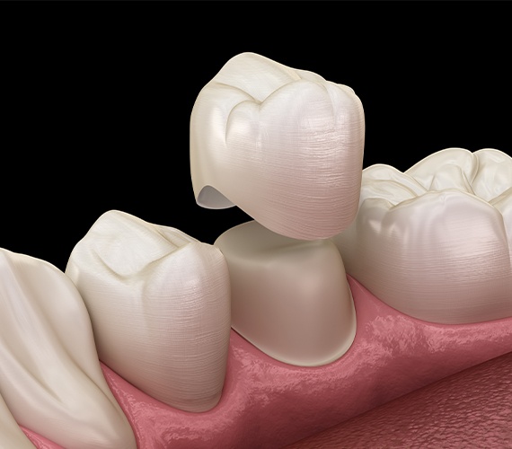 Animated dental crown restoration placement