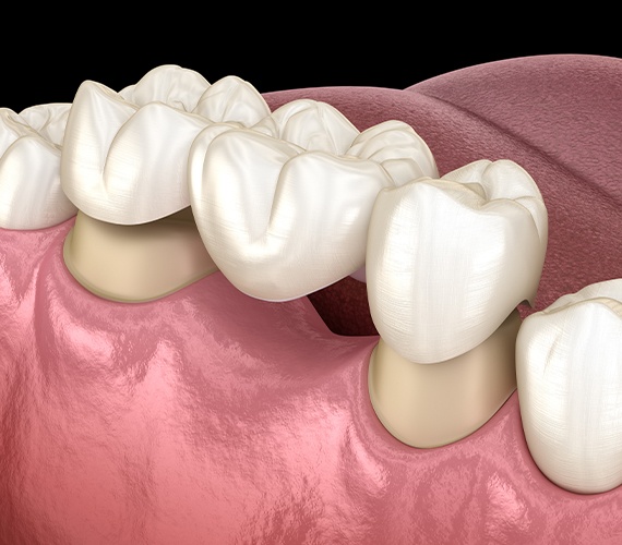 Animated dental bridge placement