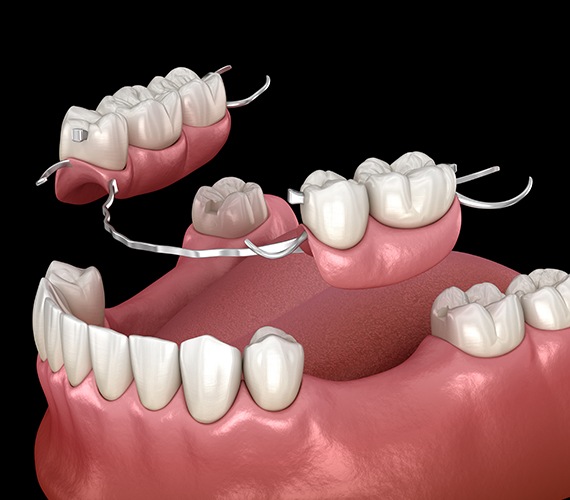 Animated partial denture placement