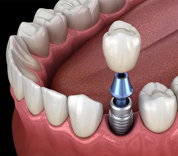 Animated dental implant supported dental crown