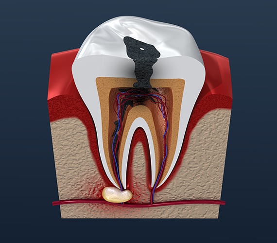 Animated tooth in need of root canal therapy