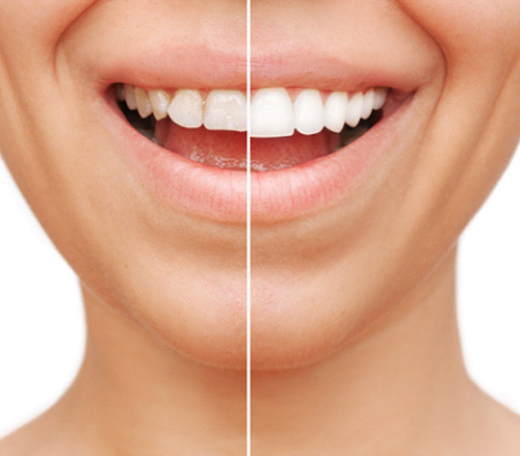 A before-and-after photo of a patient’s veneers in Fort Worth