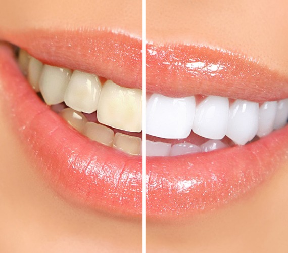 Closeup of patient's smile before and after teeth whitening