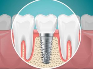 Missing back tooth treated with a dental implant.