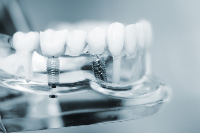clear image of dental implants in Fort Worth