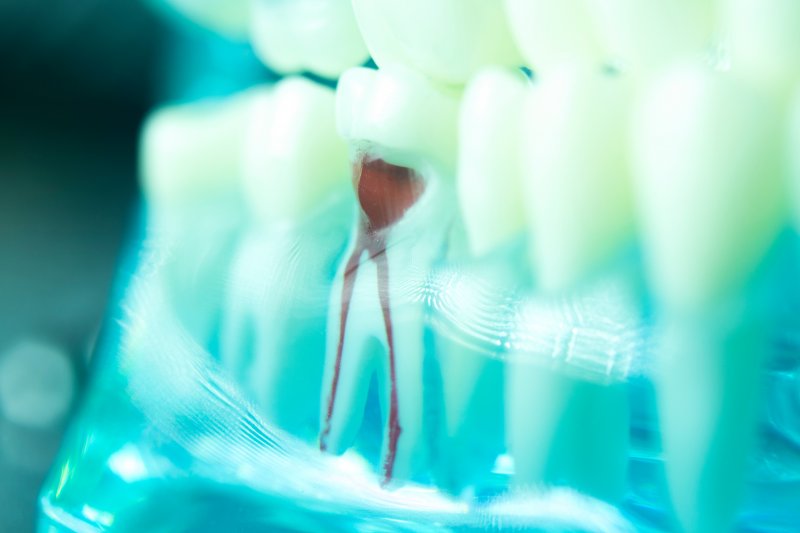 a model example of root canals in Fort Worth