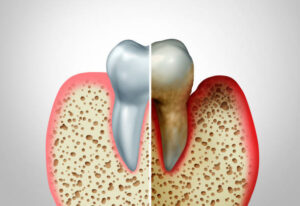 Healthy gums compared to gingivitis