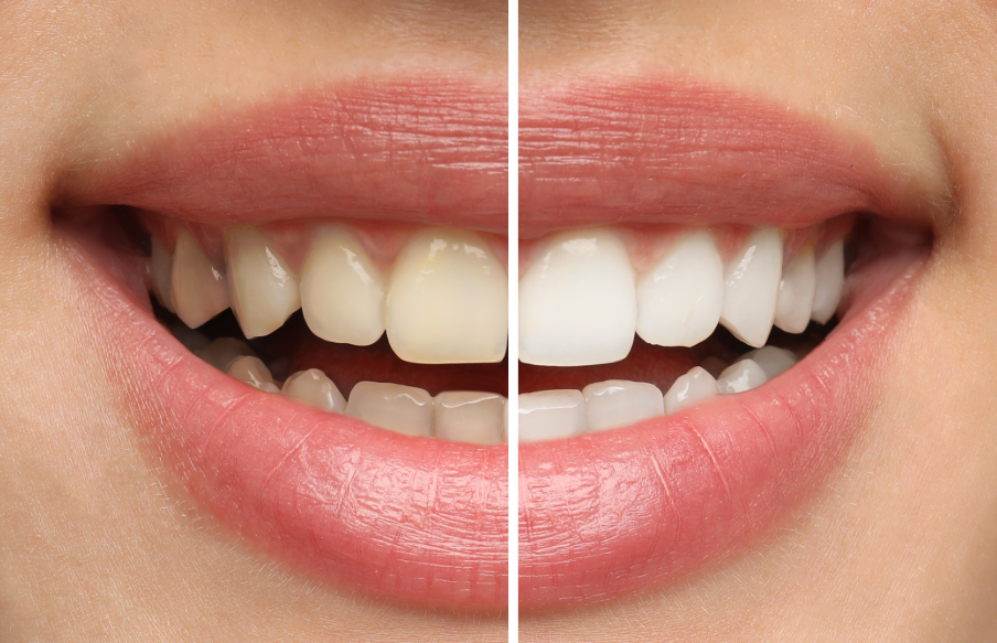 Close up of woman's smile, half white teeth, half yellow